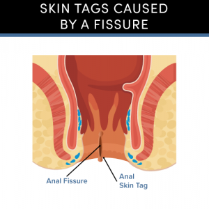 skin tags caused by fissures