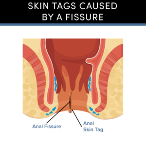 skin tags caused by fissures