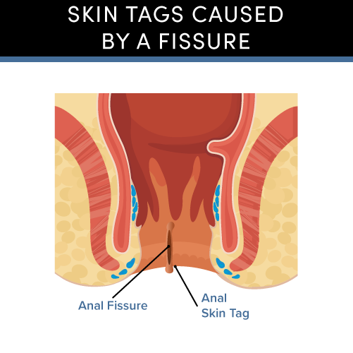 Artistic image depicting the skin tags caused by an anal fissure.