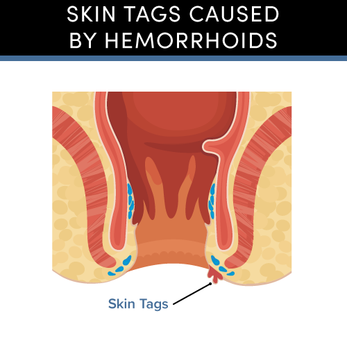 Artistic image depicting the skin tags caused by hemorroids.