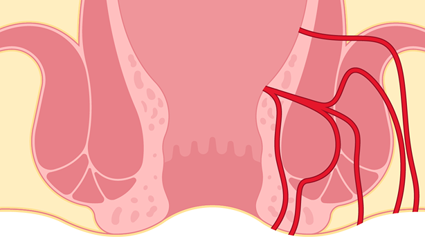 graphic of an anal fistula