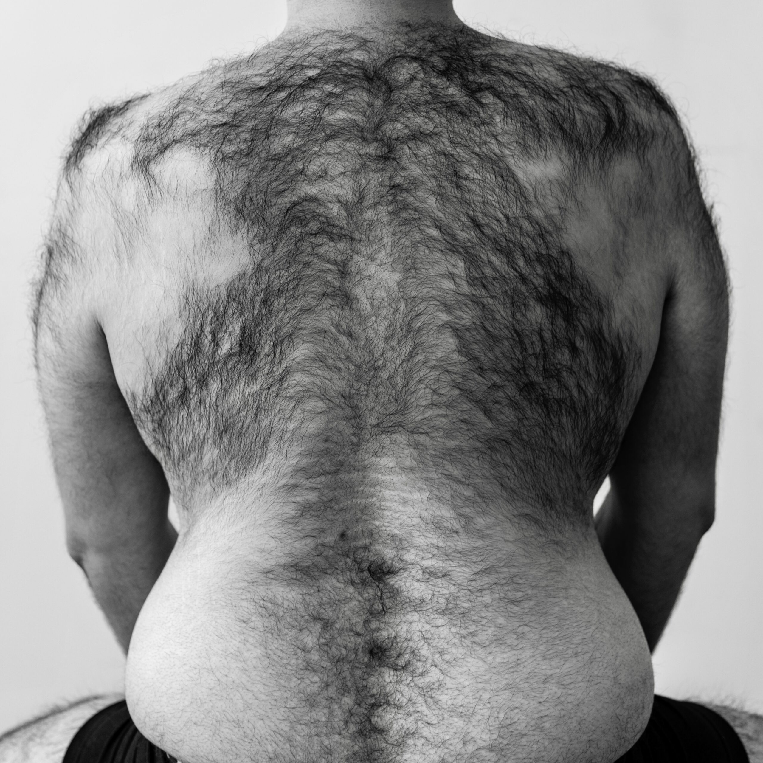 A man's back for laser hair removal