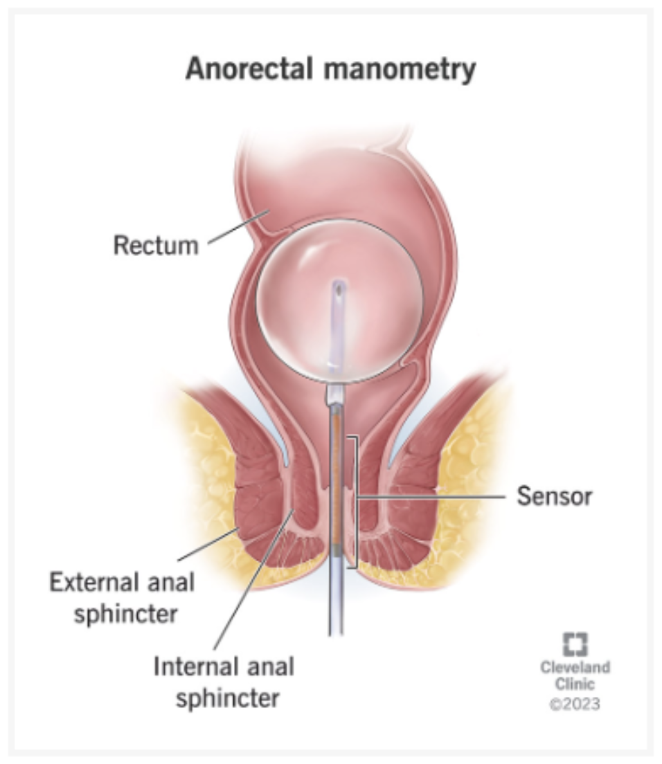 Illustration of anorectal manometry showing a sensor in the rectum, internal and external anal sphincters, with labeled parts for medical context.